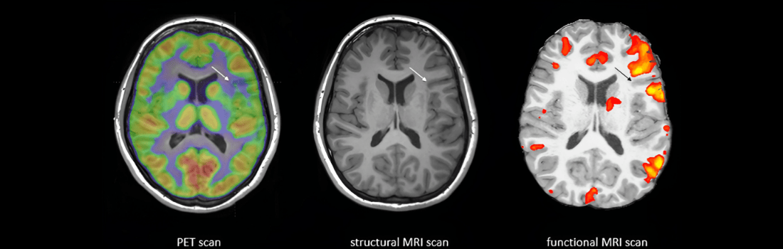 تصویربرداری مغزی مانند fMRI و PET